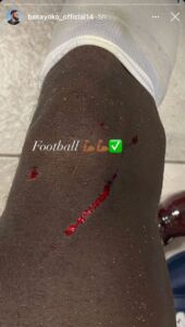 Napoli, infortunio Bakayoko: il francese mostra i segni - FOTO 34 Bakayoko